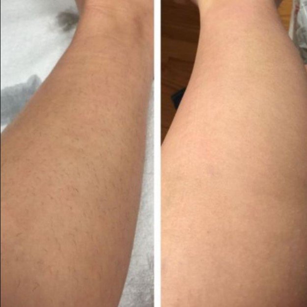 laser hair removal before and after arms