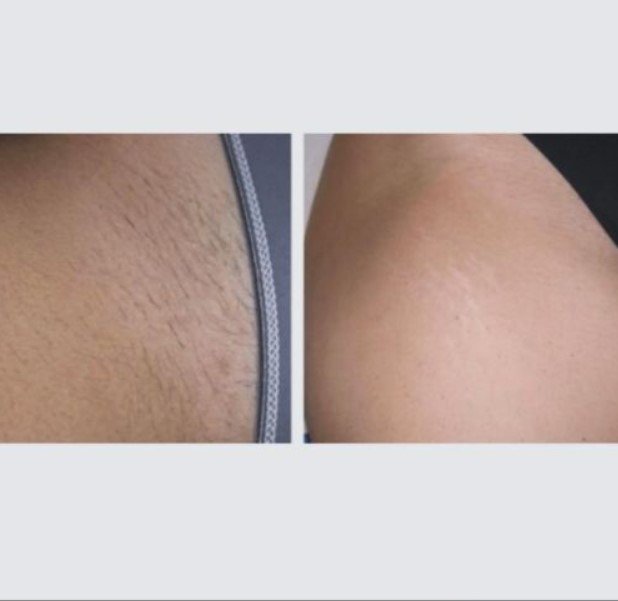 laser hair removal before and after bikini