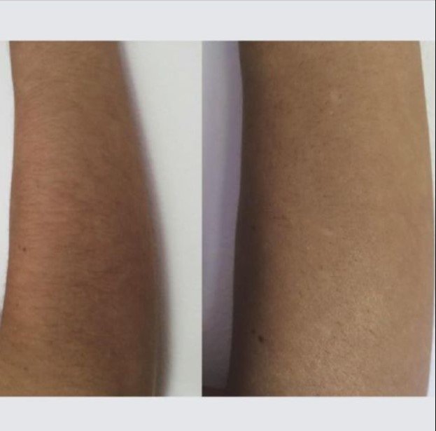 laser hair removal before and after images of arms