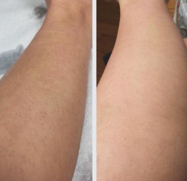 laser hair removal before and after images