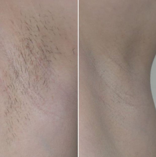 laser hair removal before and after under arm