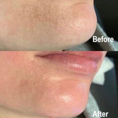 Comparison of skin before and after a facial treatment, showing noticeable improvements.