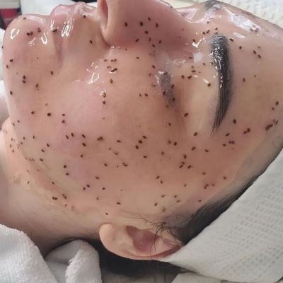 Woman undergoing a facial treatment with black dots for blackhead removal.