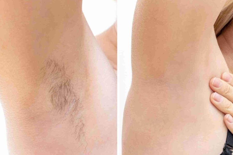 brazilian laser hair removal before after