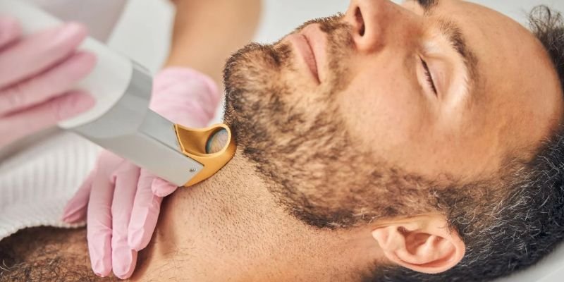 laser hair removal men beard