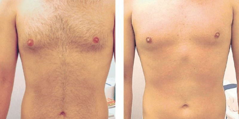 laser hair removal men before after