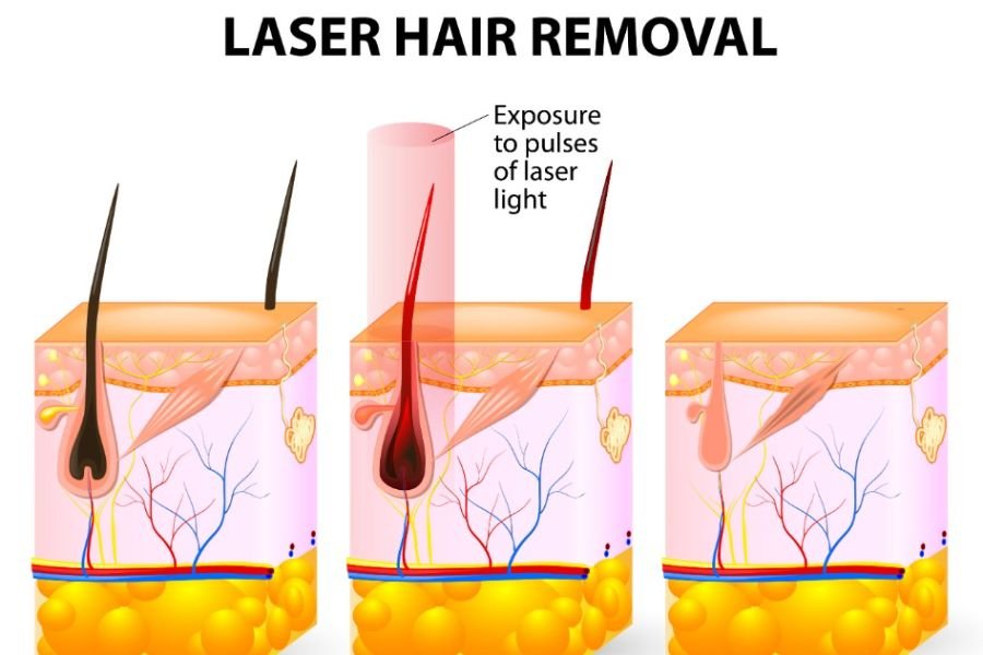 what is laser hair removal