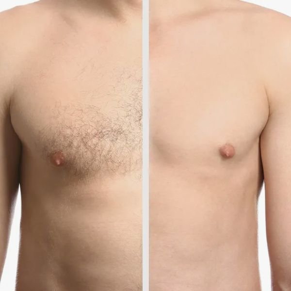 laser hair removal before and after
