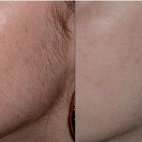 laser hair removal before and after