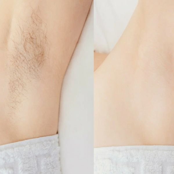 laser hair removal before and after