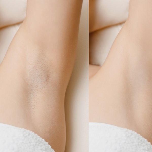 laser hair removal before and after