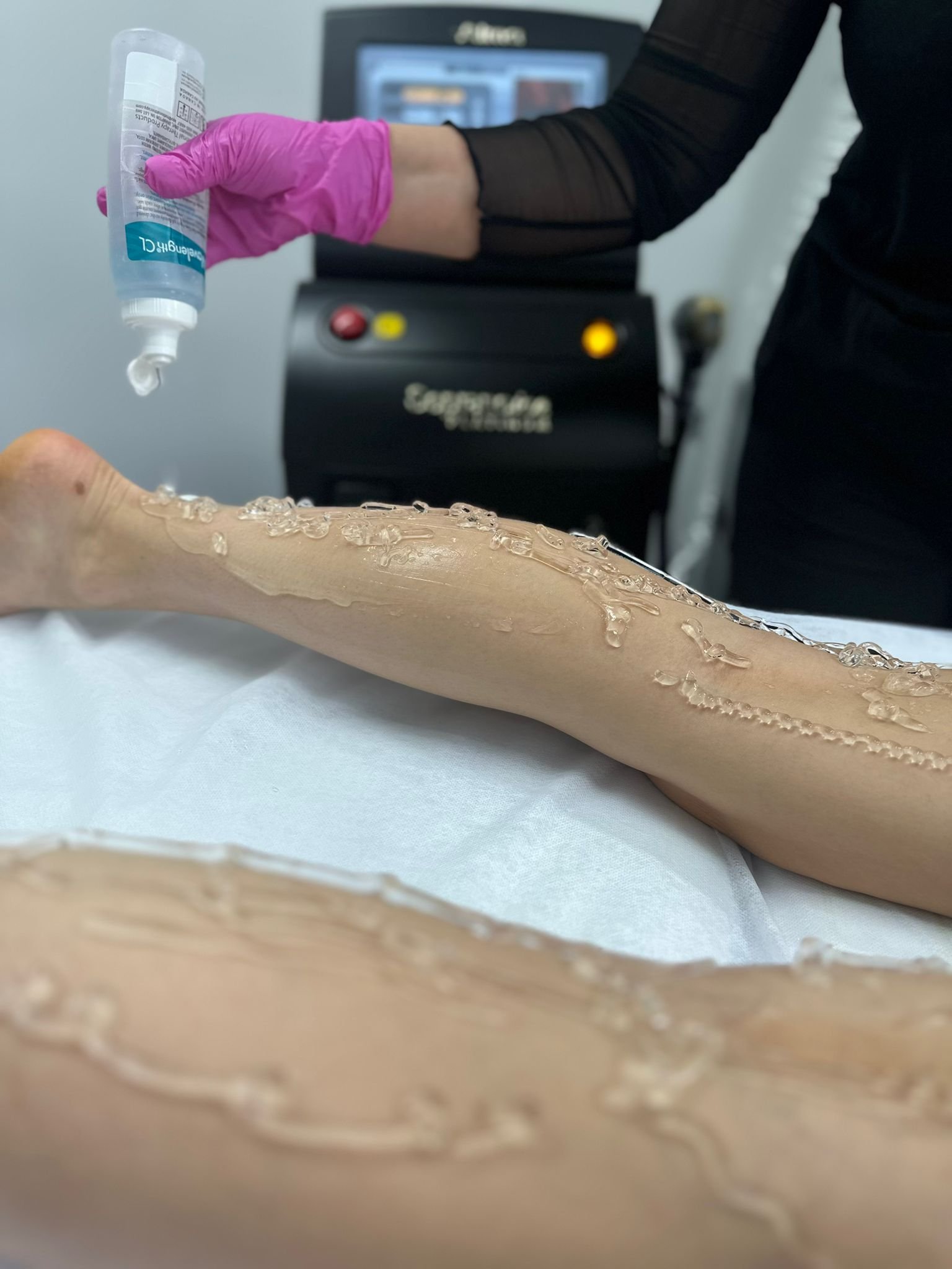 laser hair removal procedure (4)