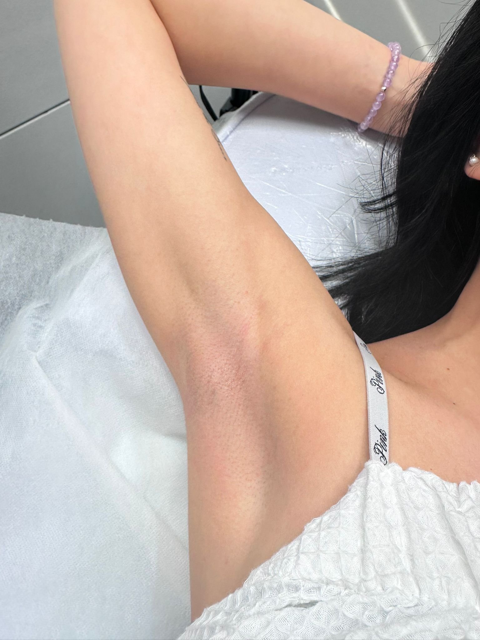 laser hair removal north york, markham