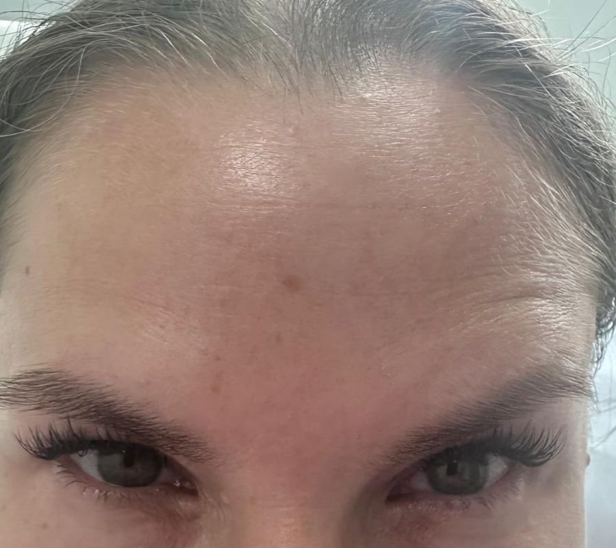 botox near north york