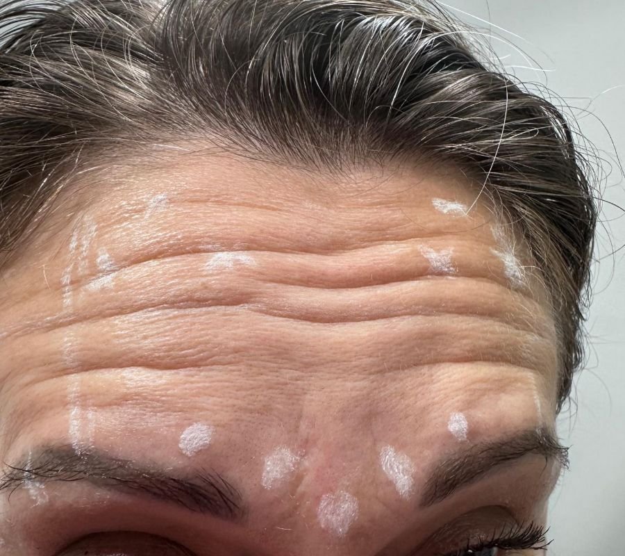 botox procedure north york