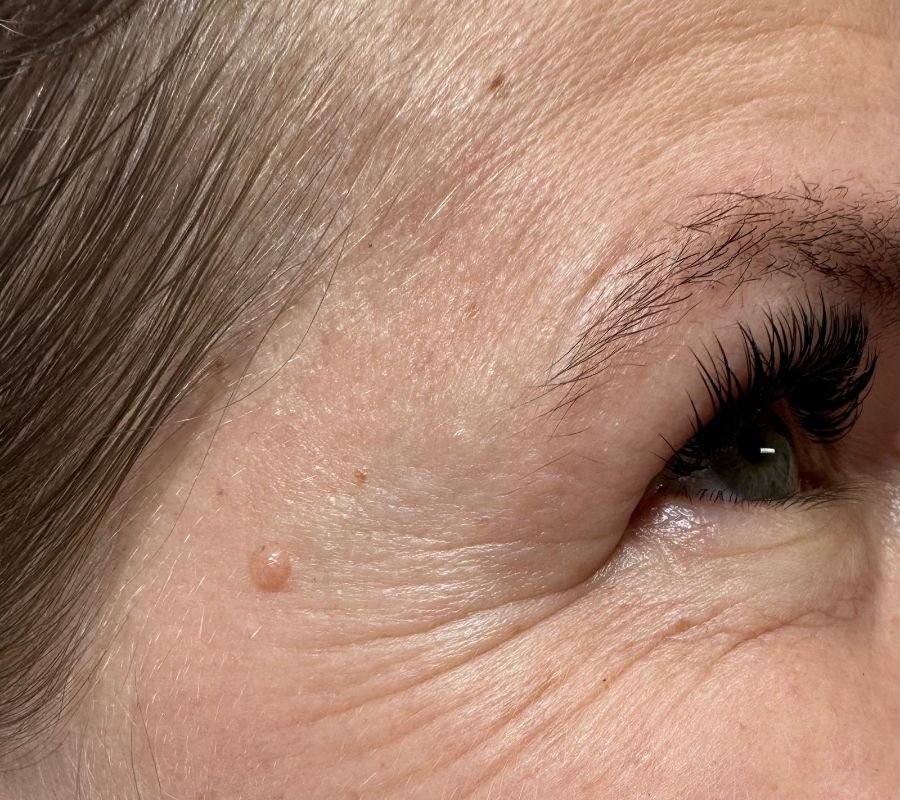 botox treatment north york on