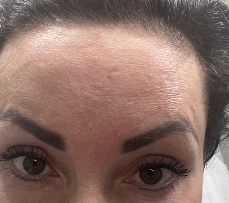 botox treatments north york