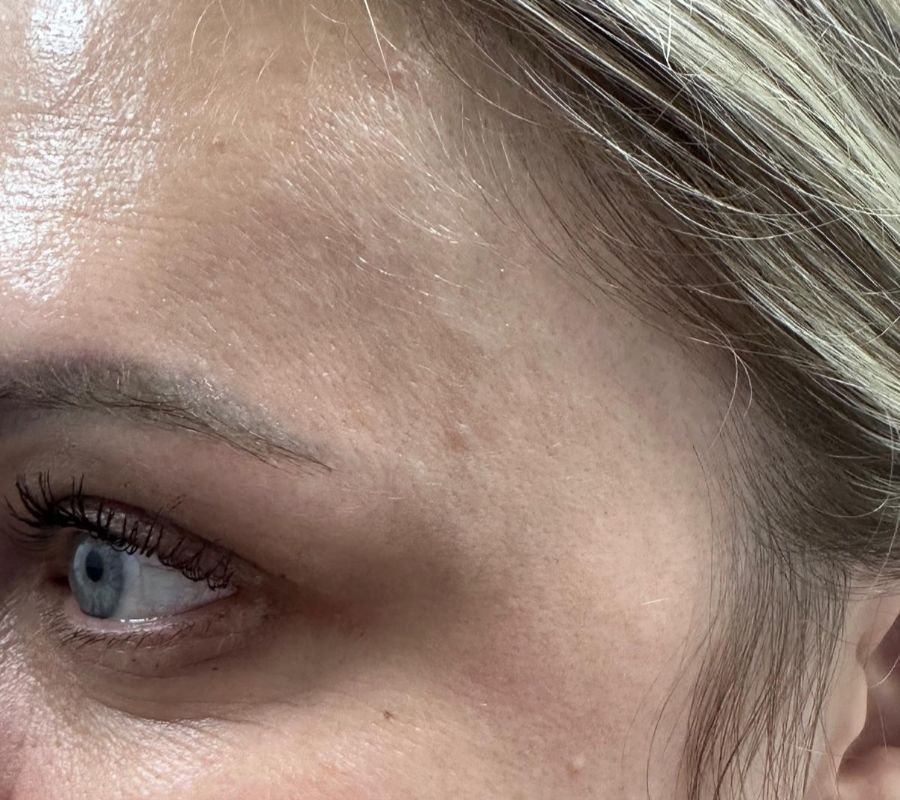 dermal filler north york