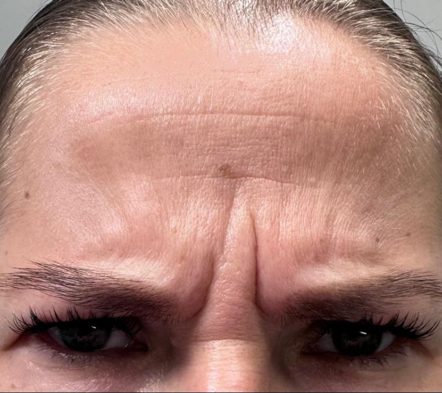 dermal filler procedure north york