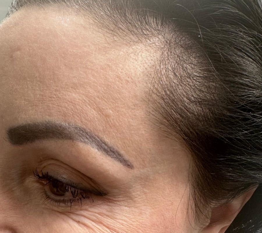 dermal fillers in north york