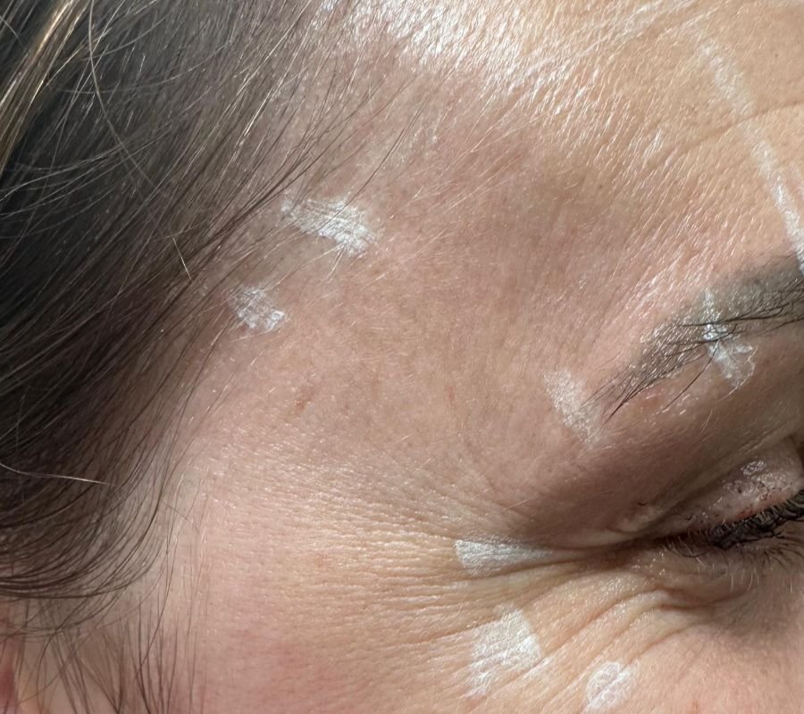 dermal fillers north york