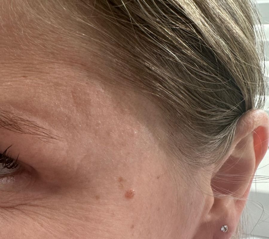 lip filler north york