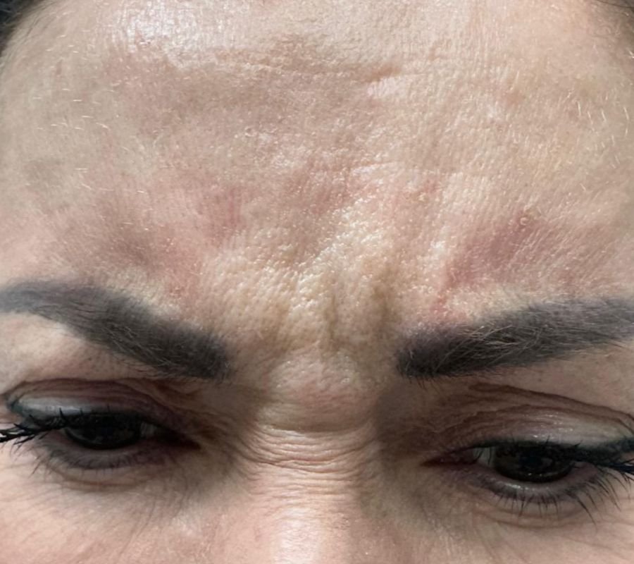 north york botox clinic