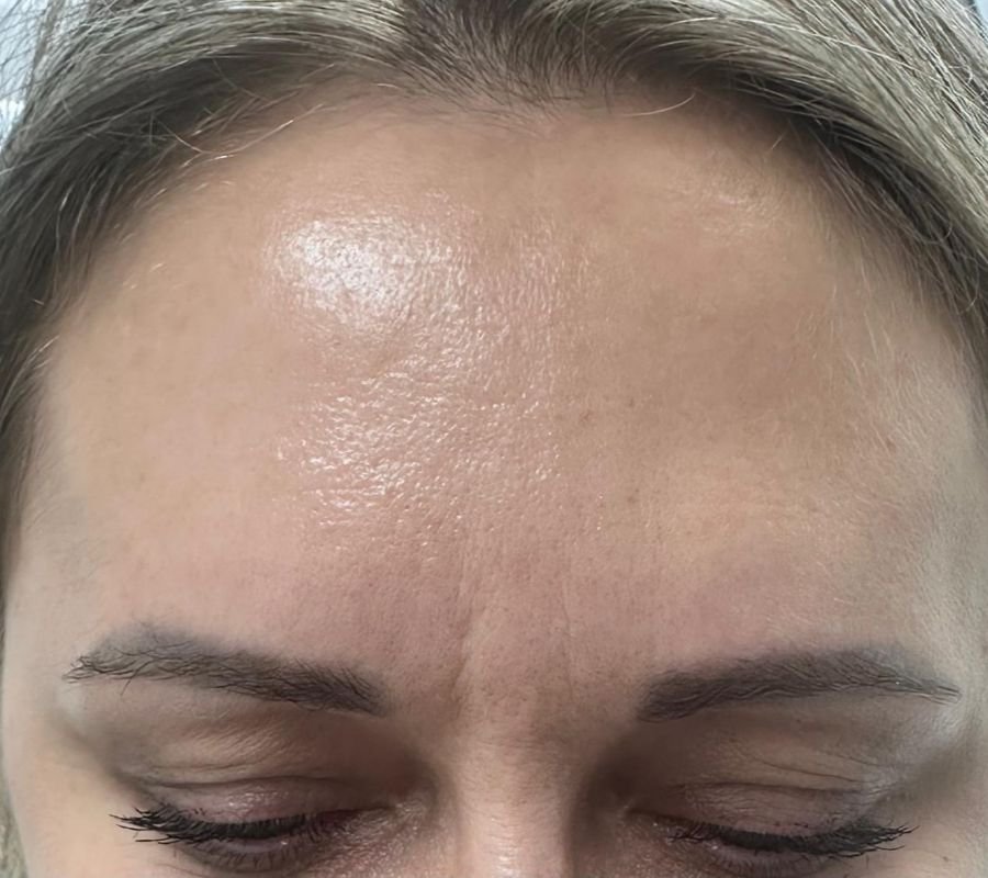 north york dermal filler clinic