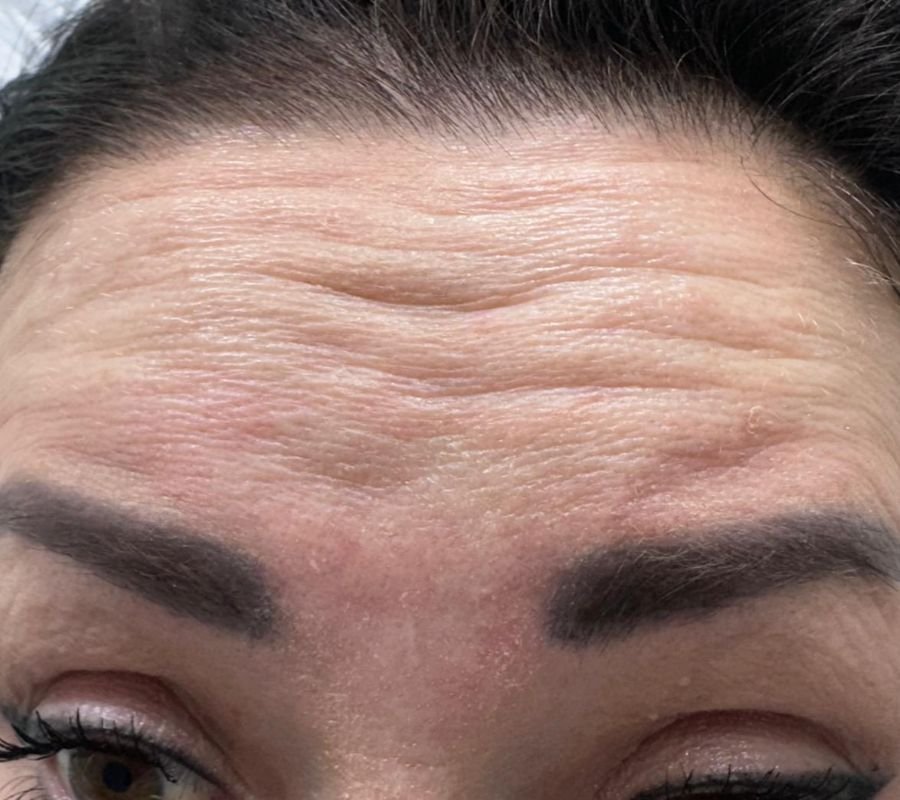 wrinkles treatment in north york