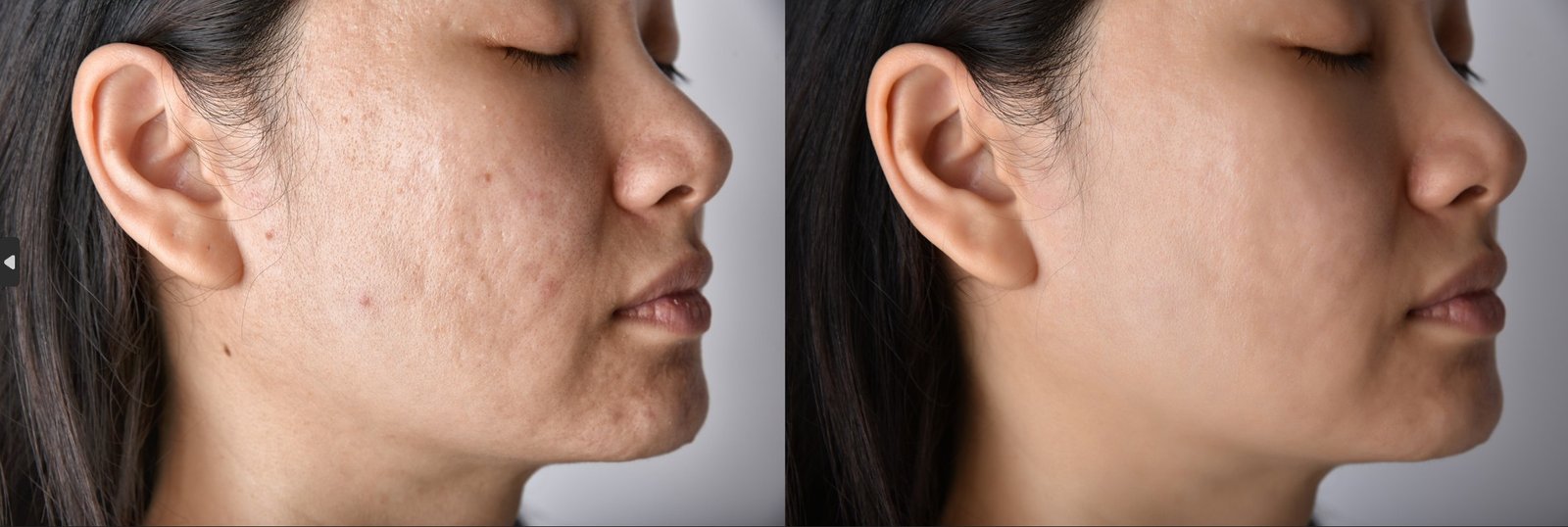 prp facial before after